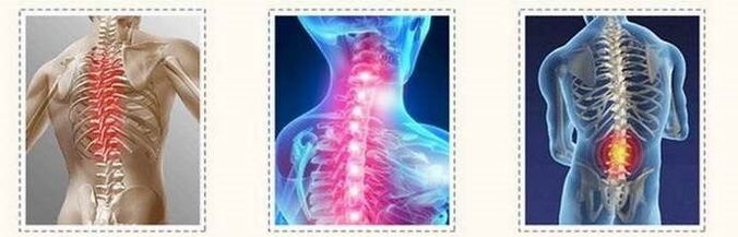 آفات العمود الفقري من العظم